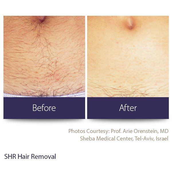 Laser Hair Removal Wilmette IL